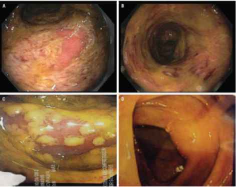 colonoscopy-reveals-pseudomembranous-plaques-in-the-colon-of-a-patient-with-clostridium-difficile-infection-a-b-and-c